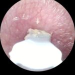 Ear Wax Removal Pro | Black Friday Sale photo review